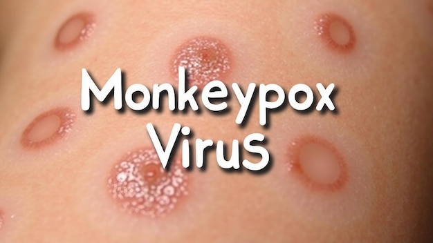 mpox virus