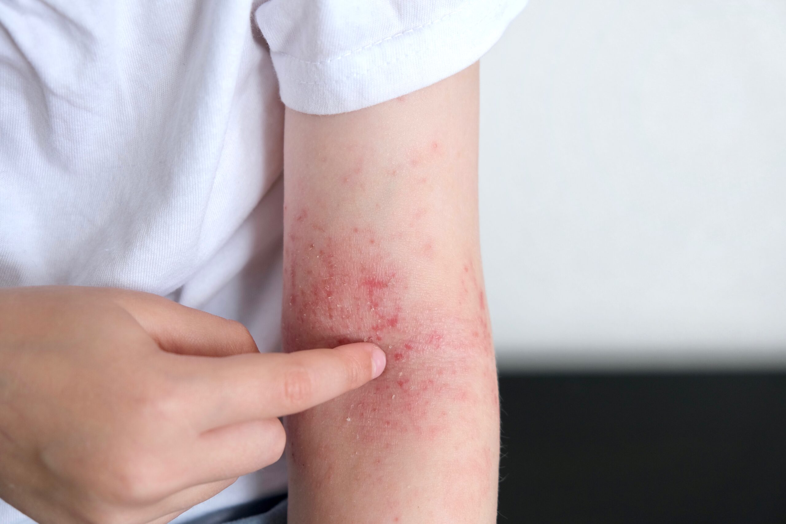 arm with red rash and irritation in studio 2026 03 17 00 06 51 utc scaled