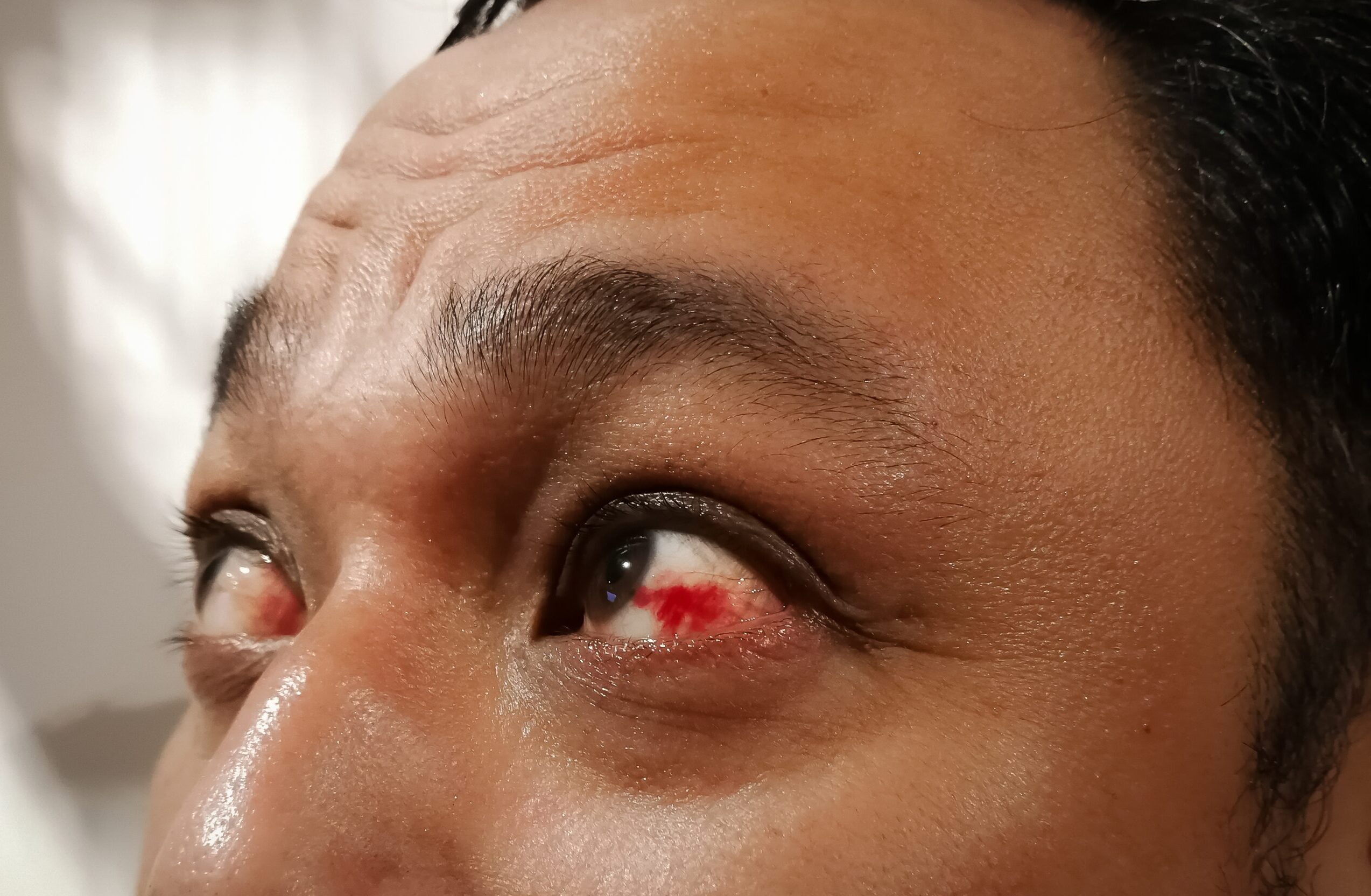 eye showing subconjunctival hemorrhage close up 2026 03 19 21 46 06 utc scaled e1782835977749